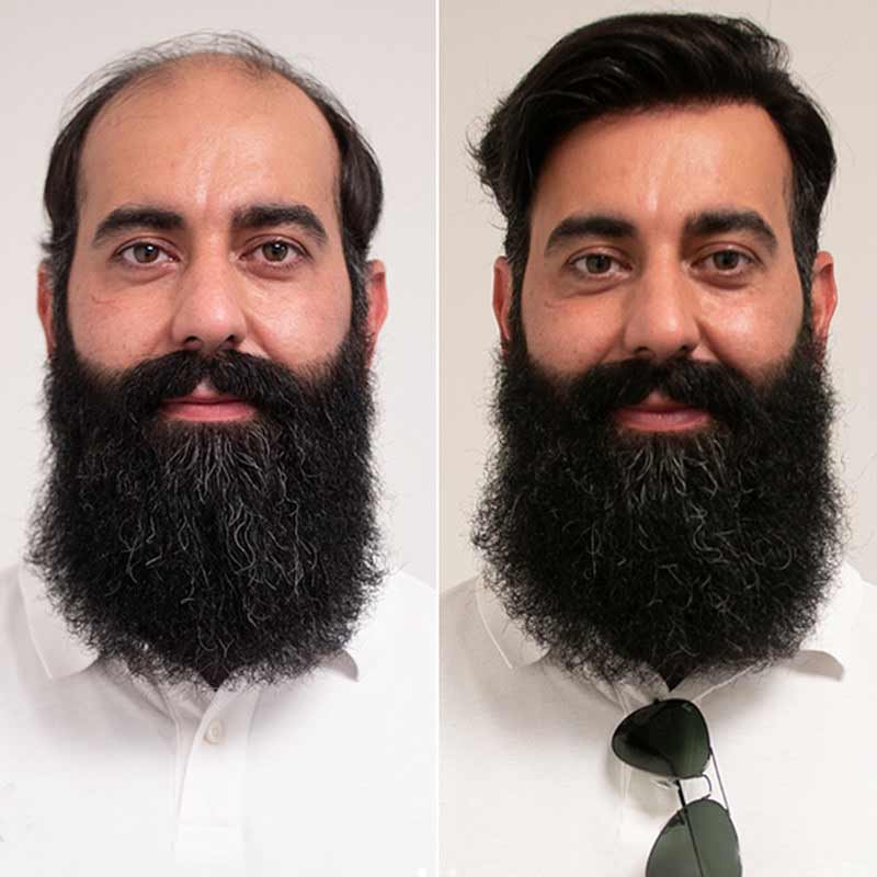 Elegant Hair Fine Mono with Thin Skin Perimeter Hair replacement for Men