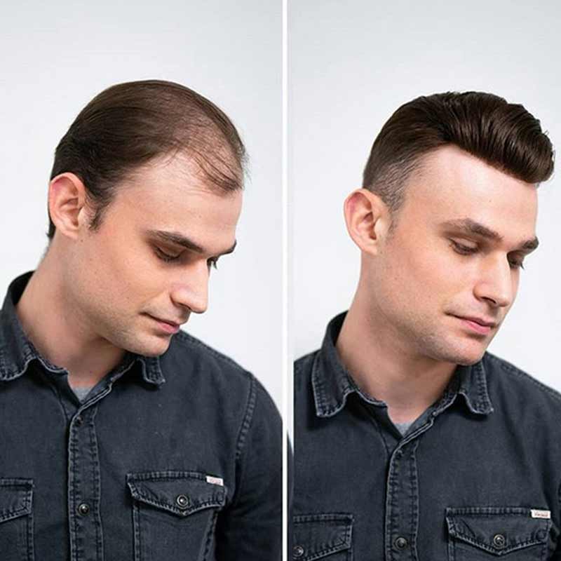 Elegant Hair Undetectable SWISS Lace with Thin Skin Back and Sides Hairpieces for Men